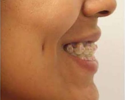 Dimple creation after result patient 2
