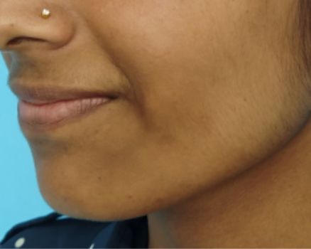 Dimple creation before result patient 1
