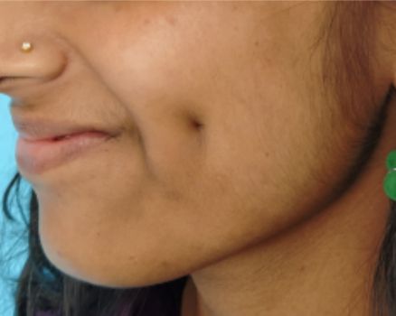 Dimple creation after result patient 1