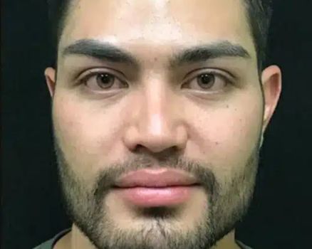 Buccal Fat Removal after result patient 1