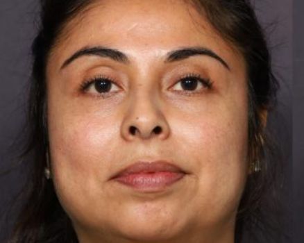 Buccal Fat Removal before result patient 2