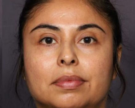 Buccal Fat Removal after result patient 2