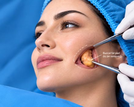 Buccal Fat Removal facial contouring