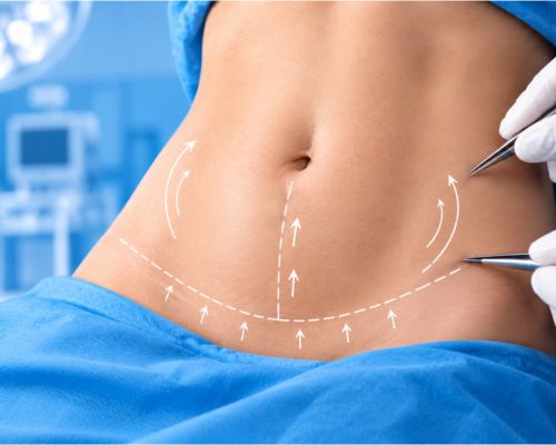 Tummy tuck consultation