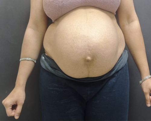 Tummy tuck before result patient 1