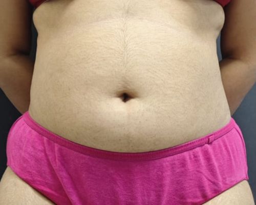 Tummy tuck before result patient 2