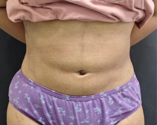 Tummy tuck after result patient 2